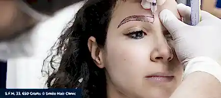 Eyebrow-Transplant-Yeni