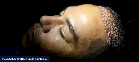 Unshaven-Hair-Transplant-02