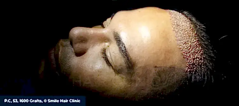 Tıraşsız Saç Ekimi