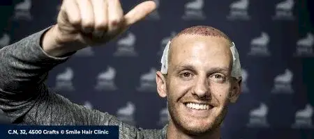 DOES HAIR TRANSPLANT WORK