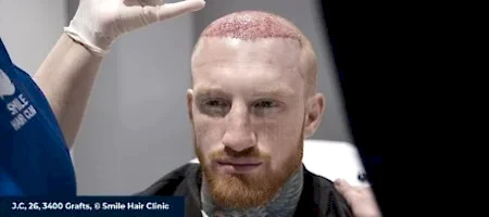 HAIR TRANSPLANT SIDE EFFECTS