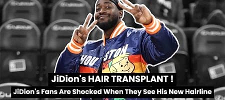 Jidion Hair Transplant