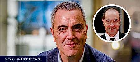 James-Nesbitt-Before-After