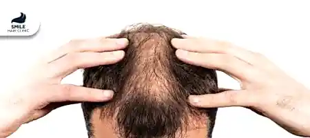 Menopoz-ve-PKOS'ta-(Polikistik-Over--Sendromu)-Saç-Dökülmesi