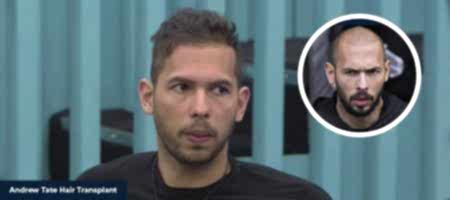 Andrew-Tate-Hair-Transplant-02