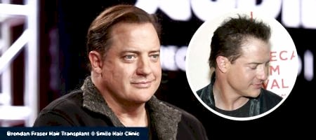 Brendan-Fraser-Hair-Transplant-01