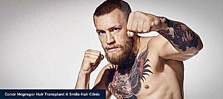 Conor-Mcgregor-Hair-Transplant-01