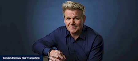 Gordon-Ramsey-Hair-Transplant-03