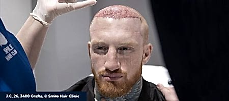 HAIR-TRANSPLANT-SIDE-EFFECTS