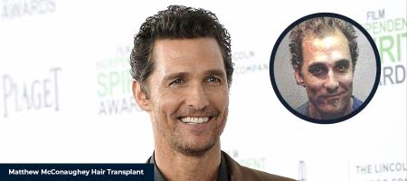 MATTHEW-MCCONAUGHEY-HAIR-TRANSPLANT-2-1