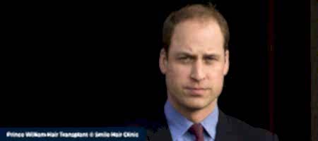 Prince-William-Hair-Transplant-3