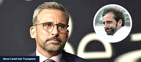 STEVE-CARELL-HAIR-TRANSPLANT-1