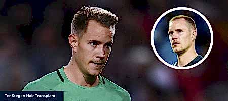 Ter-Stegen-Hair-Transplant-1