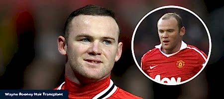 Wayne-Rooney-Hair-Transplant-1