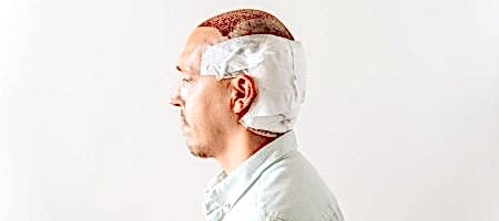 Krusten-nach-Haartransplantation-scaled-1-900x400-1